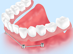 インプラントデンチャー