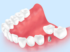 抜歯即時埋入・即時荷重インプラント