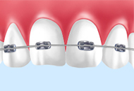ブラケット矯正