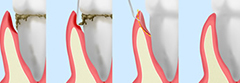 歯周ポケット掻爬（そうは）