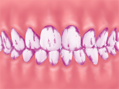 歯垢の染め出し
